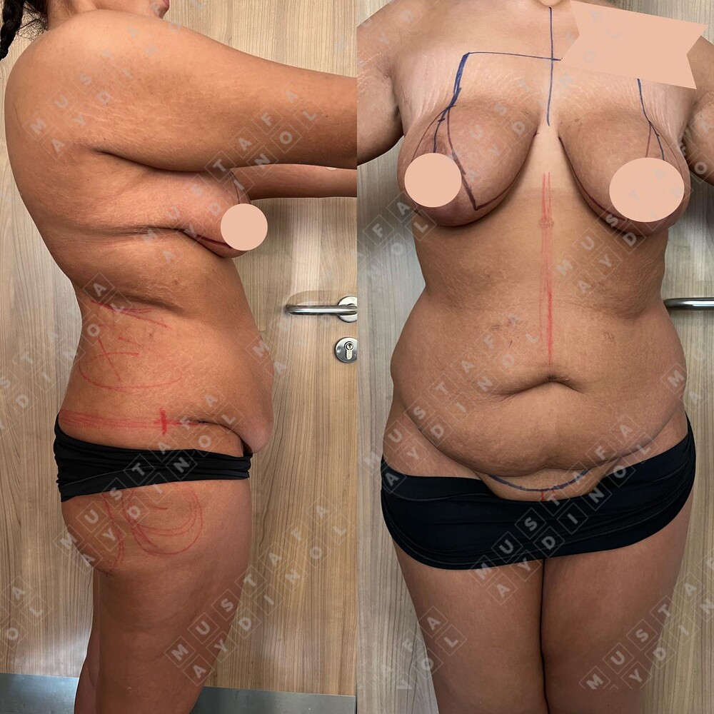 Before and After Result